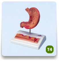 Model żołądka człowieka z owrzodzeniem 1/2  naturalnej wielkości